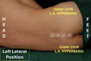 Raquianestesia Unilateral