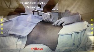 Anestesia espinhal sensível com lidocaína hipobaríca 0,6% para cirurgia anoretal em posição jack-knife